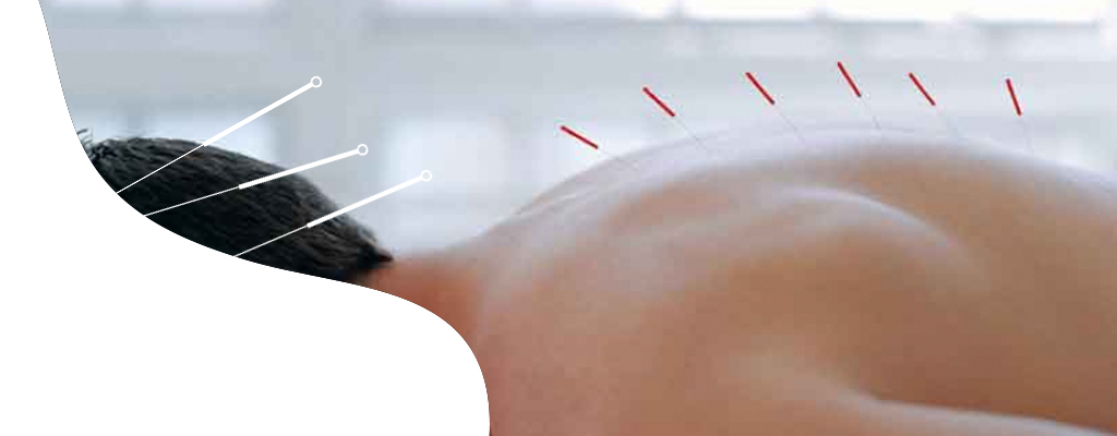 Acupuntura - Diagnostico y tratamiento con agujas en la espalda